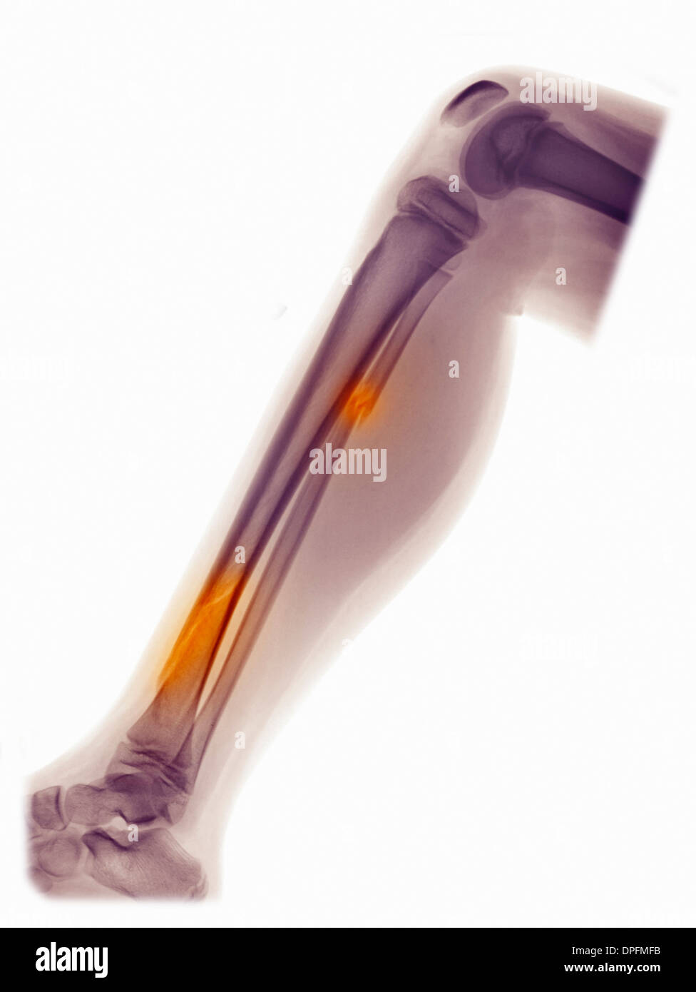 X-ray of leg showing fracture of fibula and tibia Stock Photo