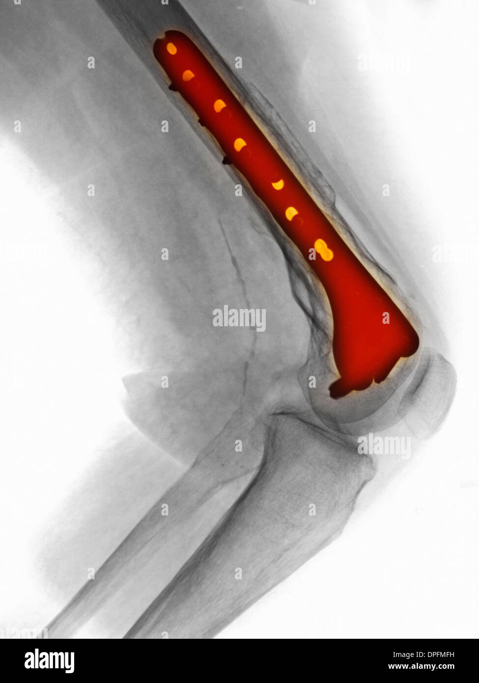 X-ray of leg showing fracture of the femur Stock Photo