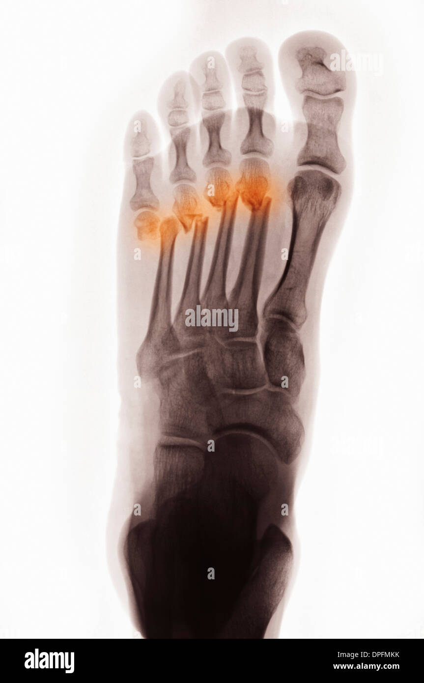 X-ray of foot with fracture of metatarsal Stock Photo