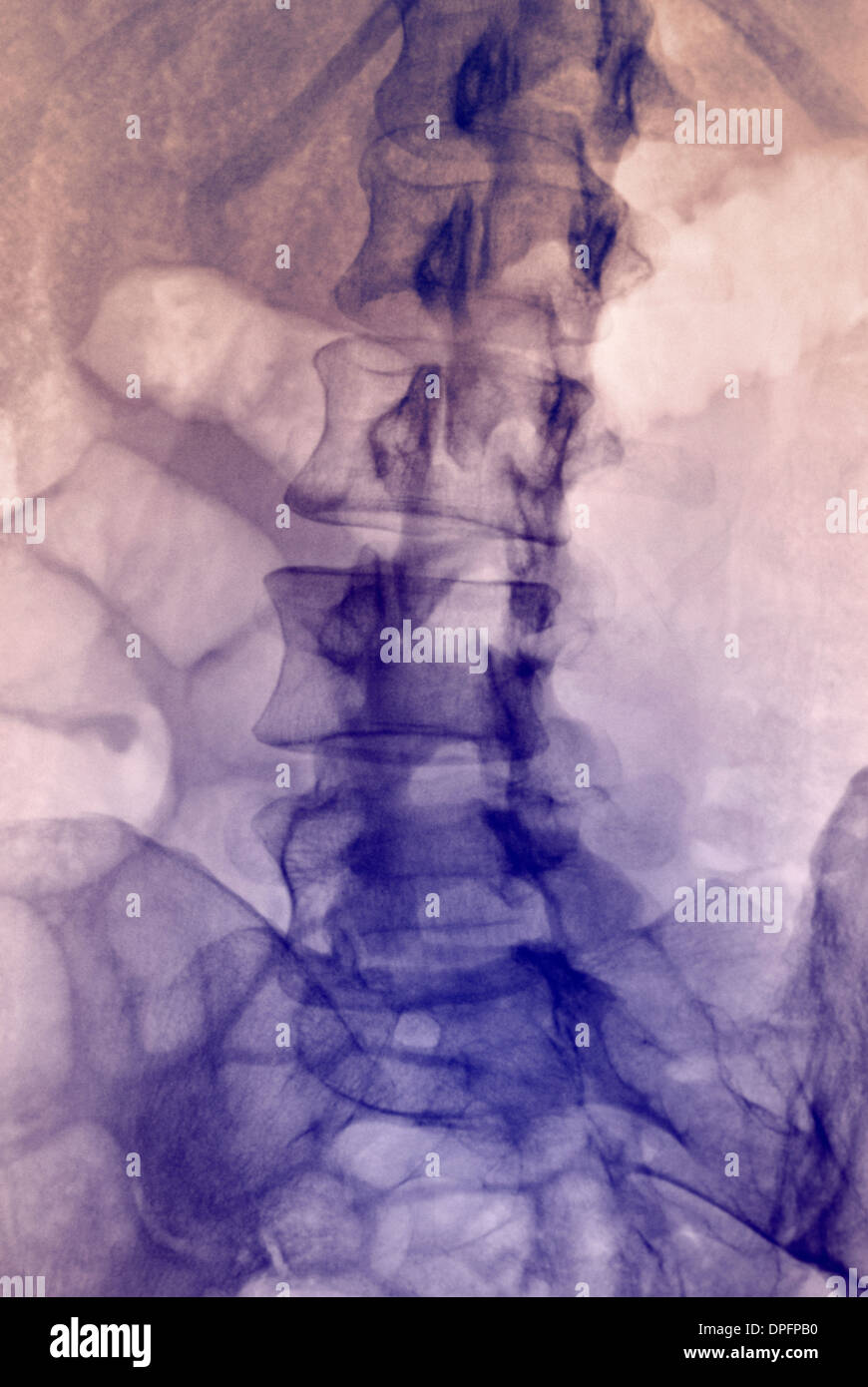 X-ray of normal lumbar spine Stock Photo