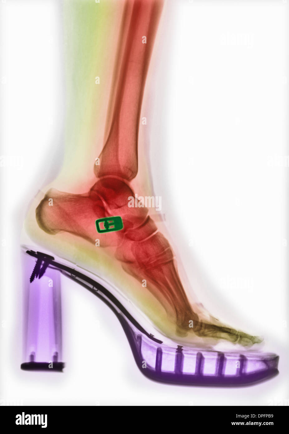 colorized x-ray of foot in a high-heeled shoe Stock Photo