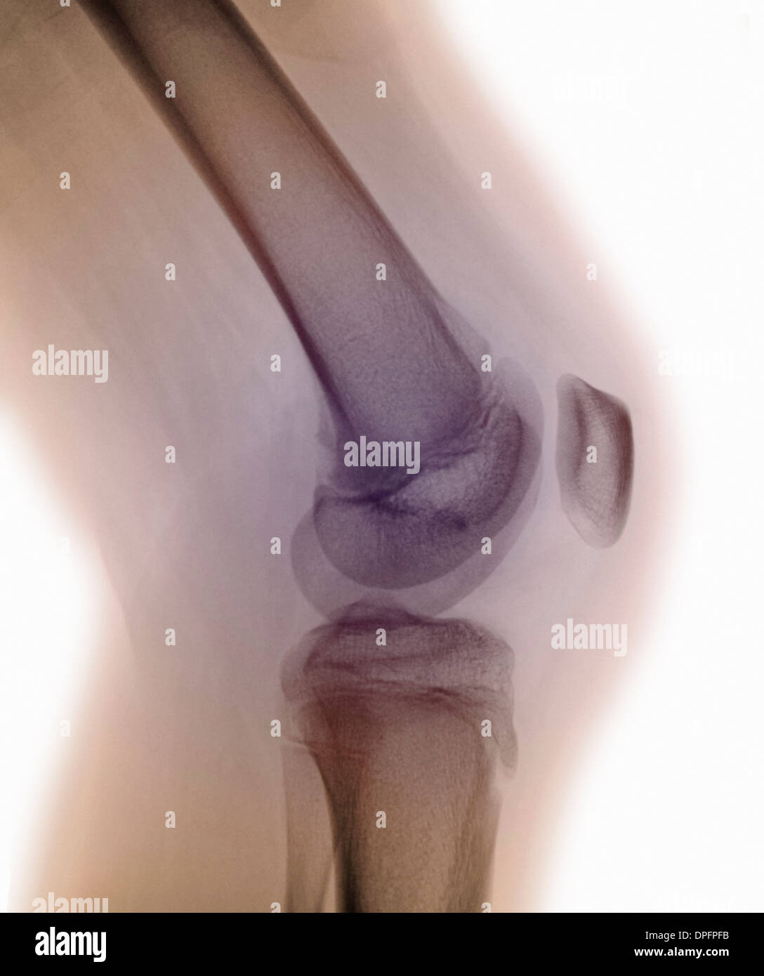 normal knee x-ray Stock Photo