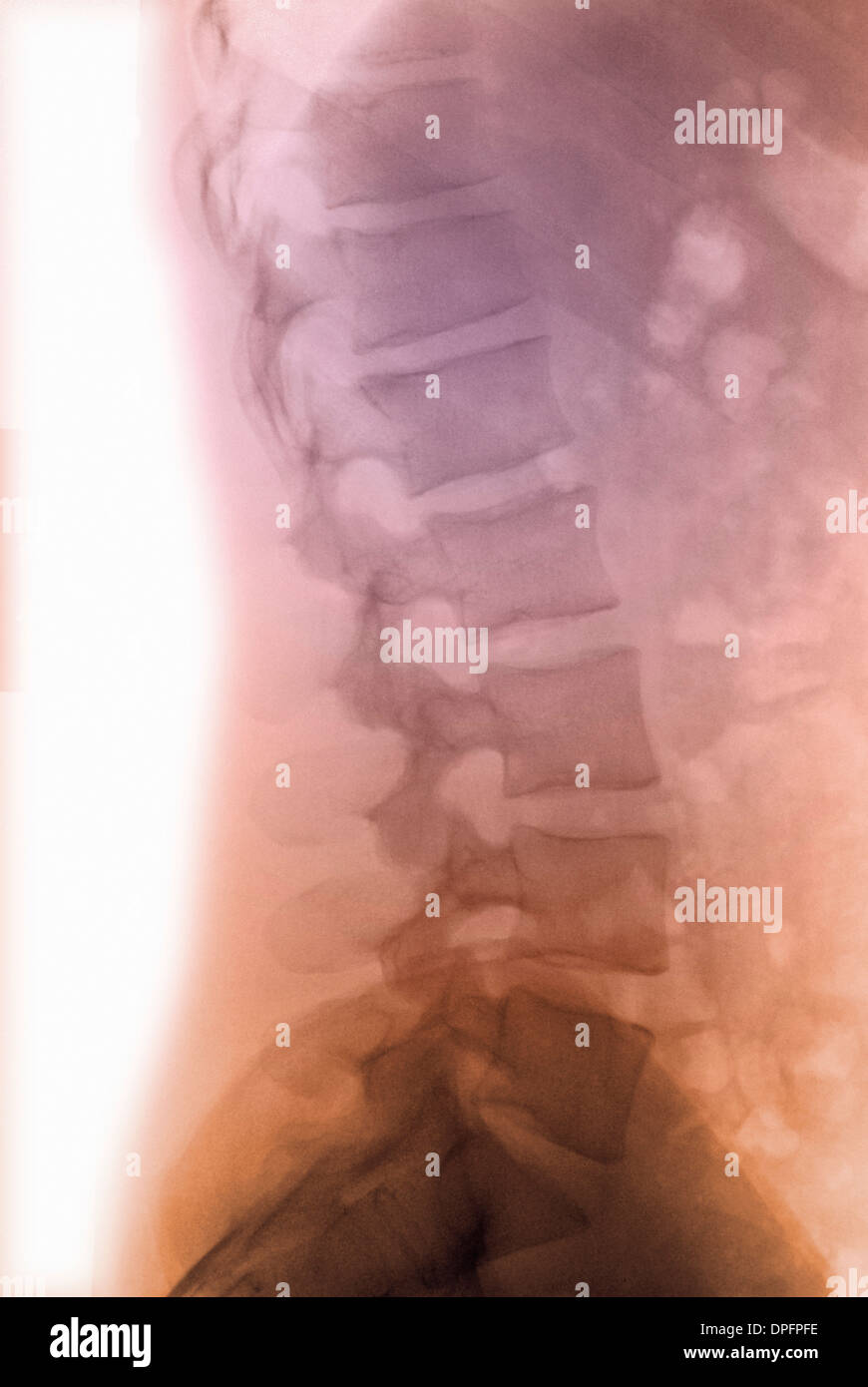 normal x-ray of the lumbar spine Stock Photo