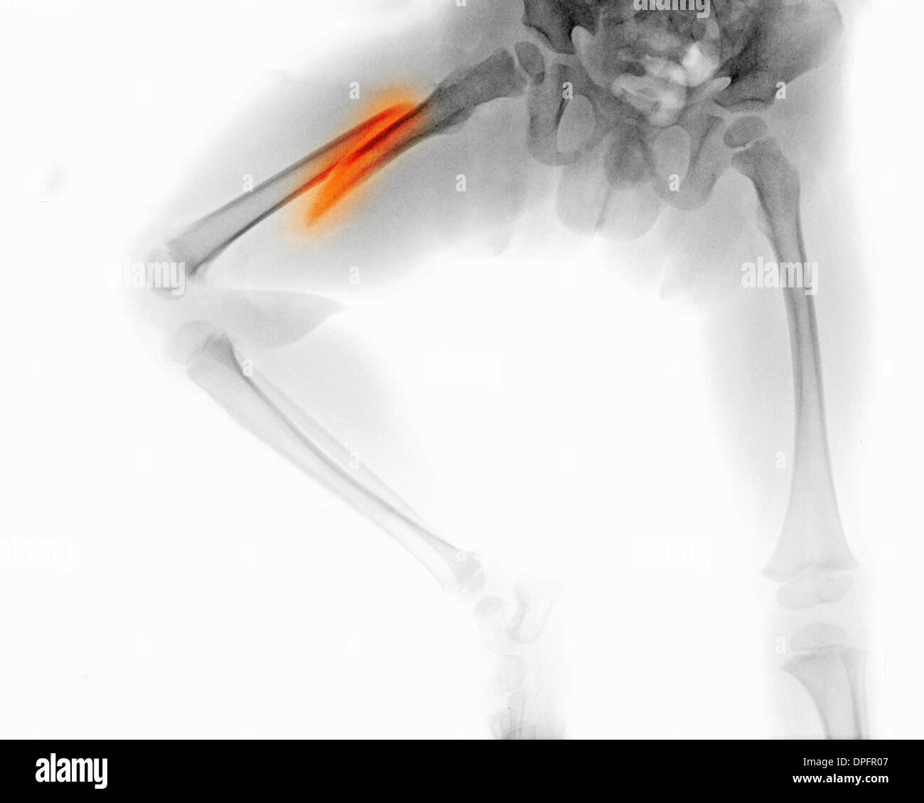 x-ray showing a femur fracture of a 3 year old boy Stock Photo