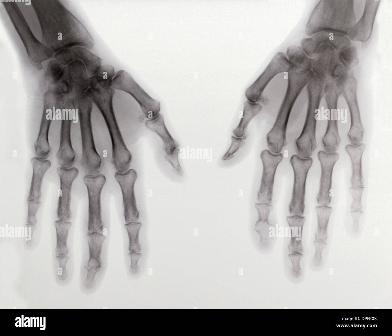 X-ray of two hands showing rheumatoid arthritis Stock Photo