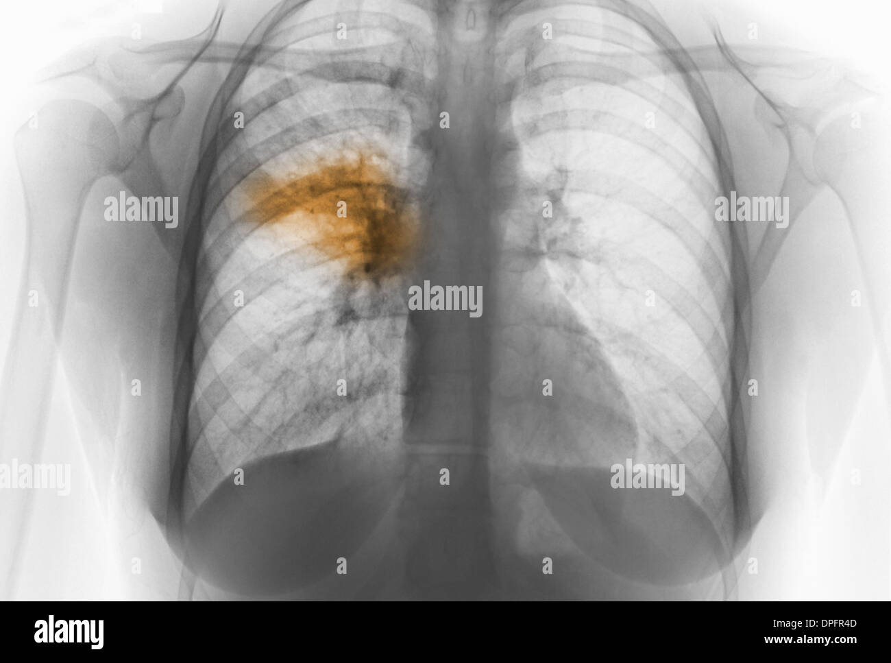 X-ray of chest showing pneumonia Stock Photo