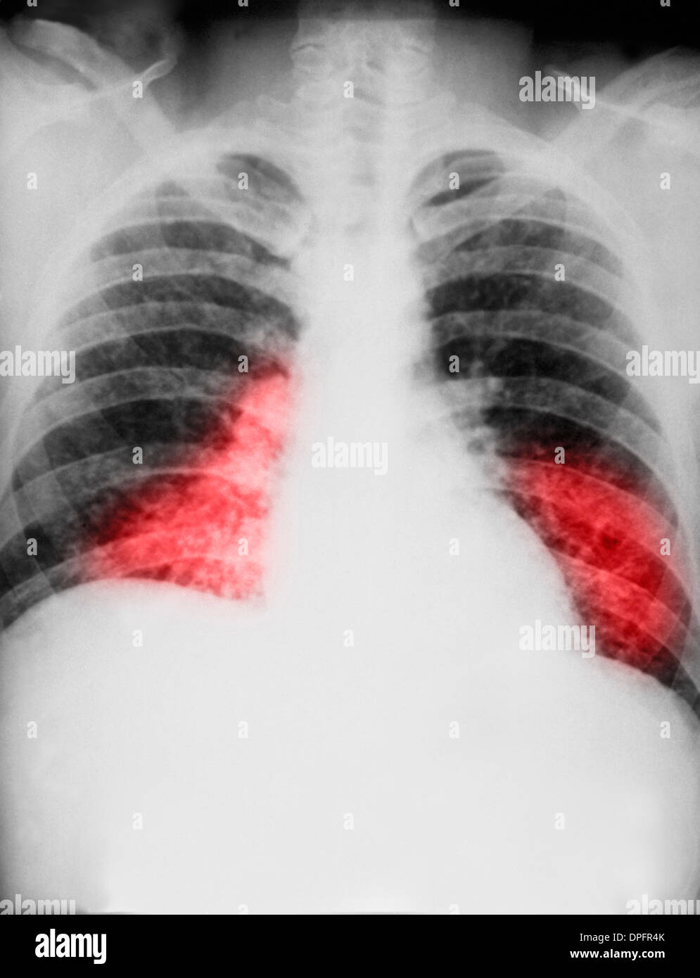 chest x-ray of histoplasmosis fungal infection Stock Photo