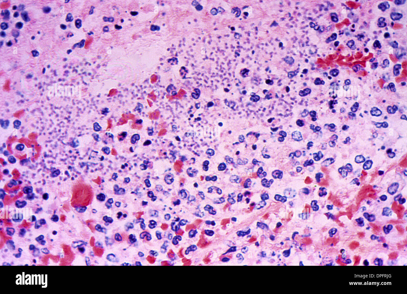 splenic tissue in a case of fatal human plague Stock Photo