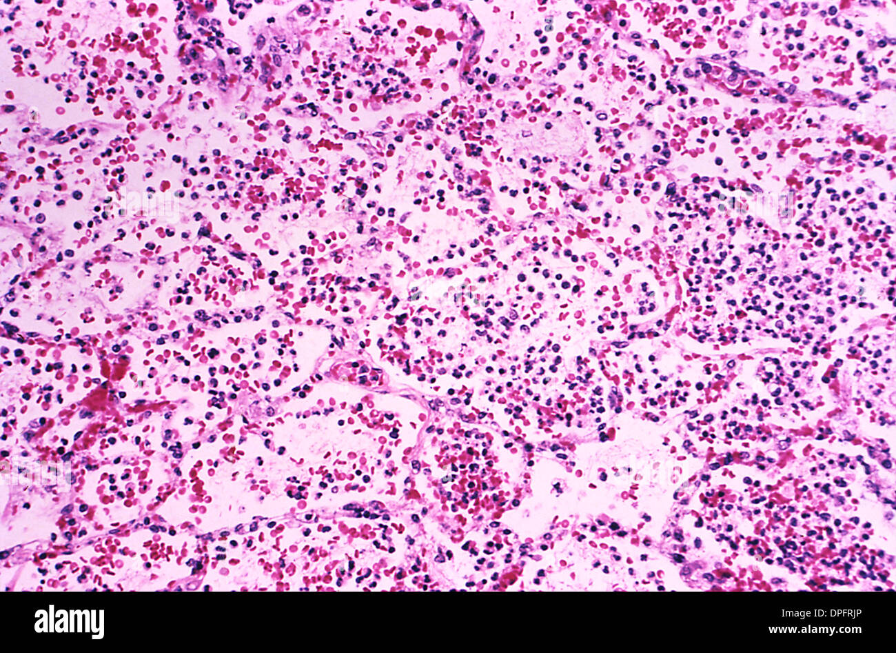 lung tissue in a case of human plague pneumonia Stock Photo
