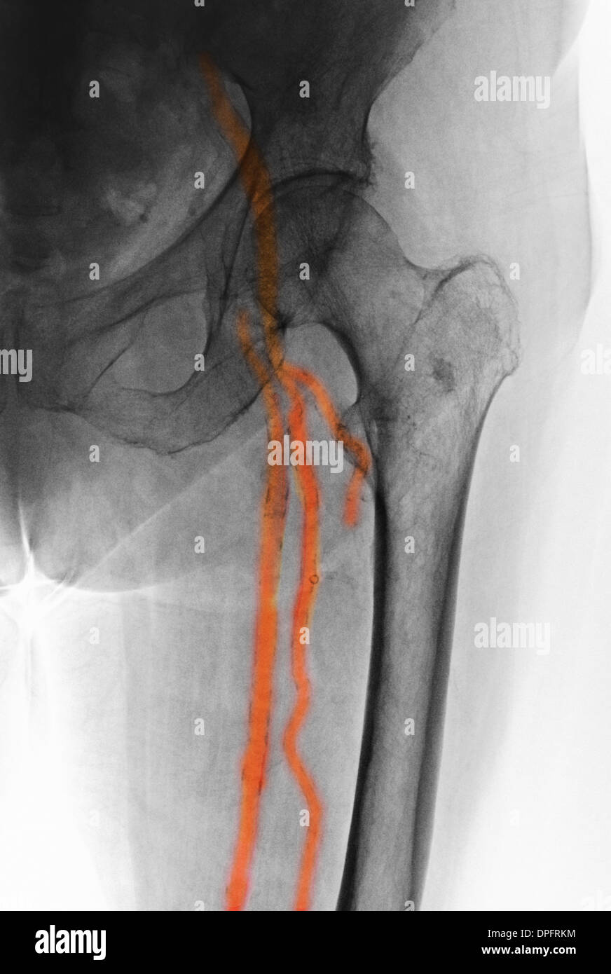 x-ray of artery calcifications Stock Photo
