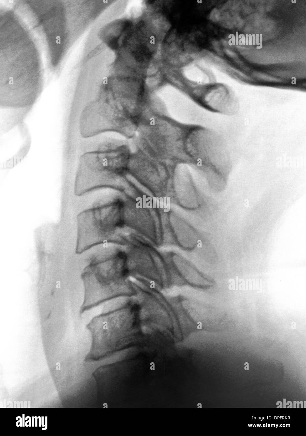 Normal neck bones hires stock photography and images Alamy