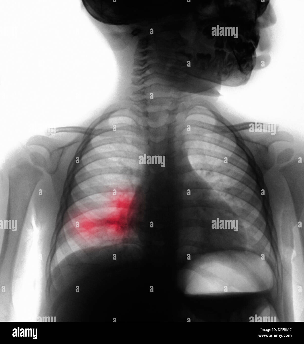 chest x-ray right middle lobe pneumonia Stock Photo