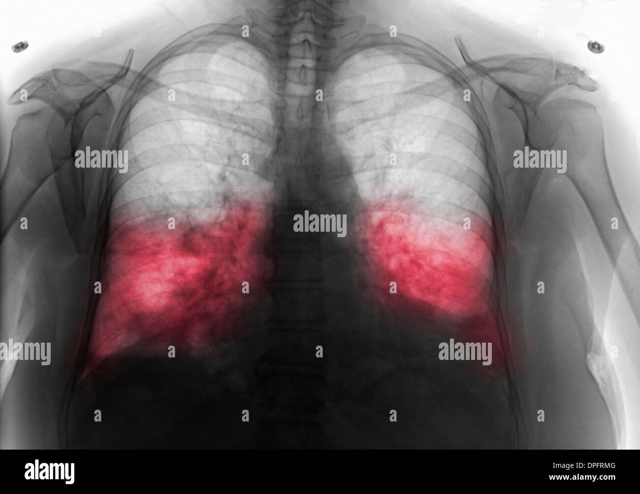 chest x-ray showing bilateral pneumonia Stock Photo