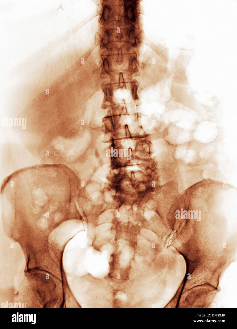 spine x-ray with degenerative arthritic changes Stock Photo