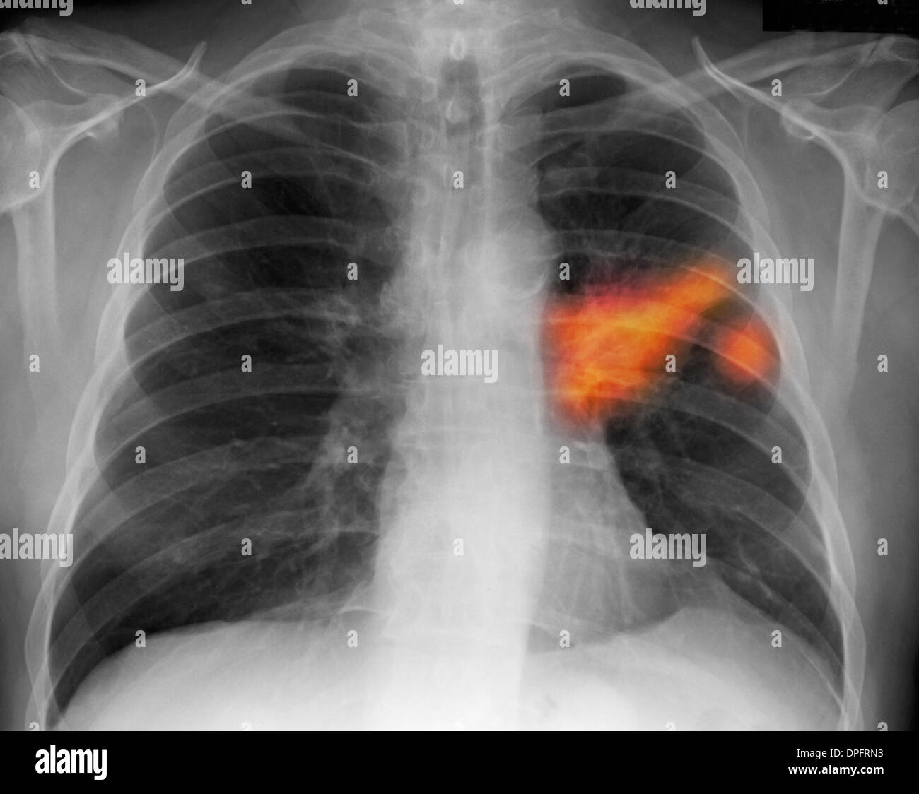 Chest x-ray of a smoker showing lung cancer Stock Photo