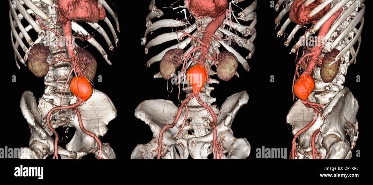CT scan images of an abdominal aortic aneurysm Stock Photo