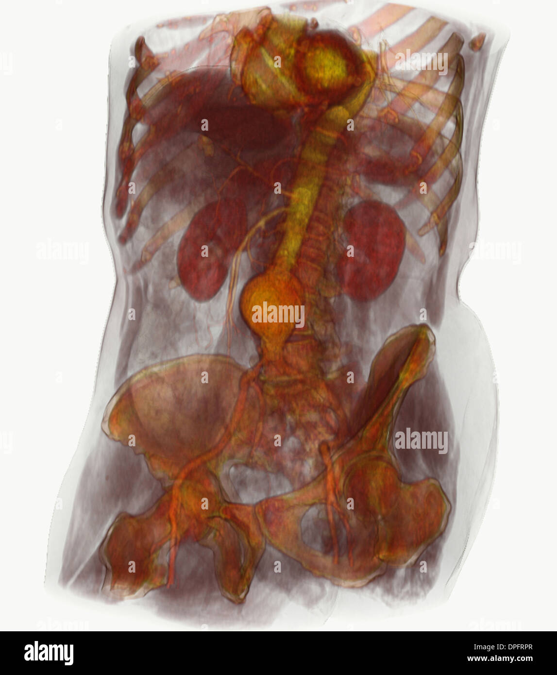 CT scan image showing an abdominal aortic aneurysm Stock Photo
