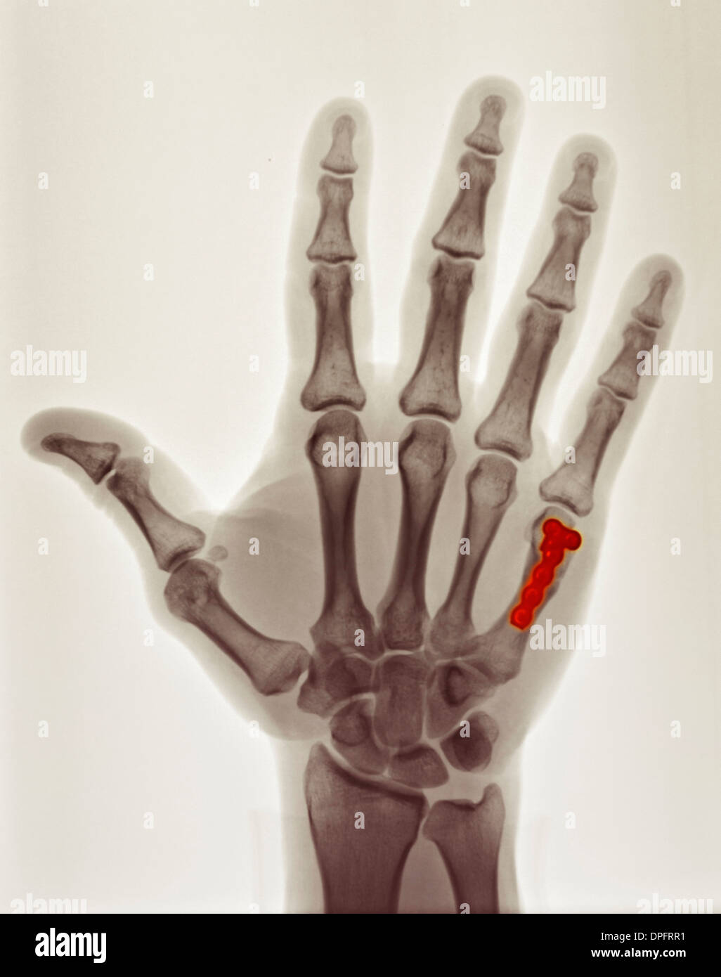 Bone fracture healing hires stock photography and images Alamy