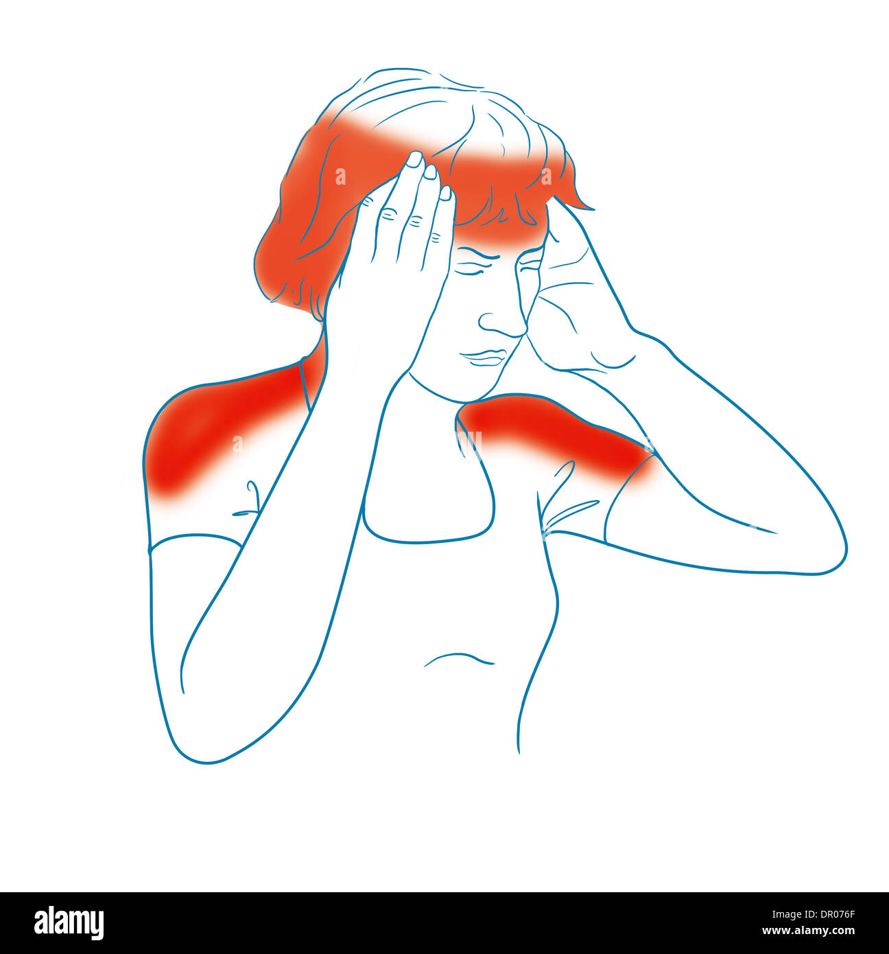 MIGRAINE, ILLUSTRATION Stock Photo