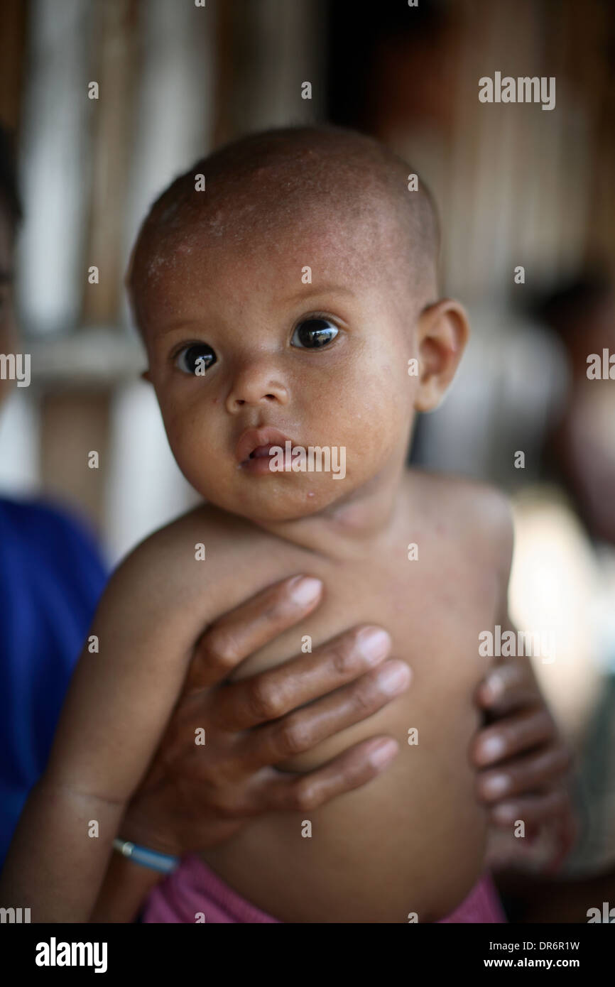 Portrait of baby with skin rash, from a family living in poverty.  Kupang, West Timor, Indonesia. Nov 2005 Stock Photo