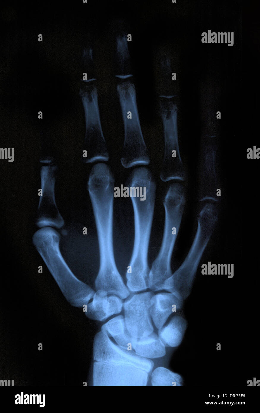 Rontgen hand hi-res stock photography and images - Alamy