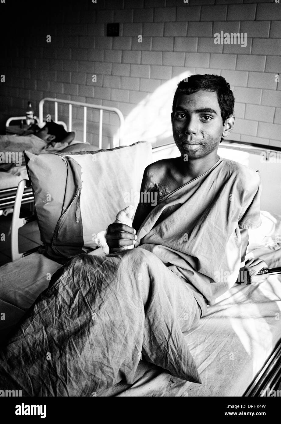 Young rural indian boy burns patient in the Sathya Sai Baba Super Speciality hospital. Puttaparthi, Andhra Pradesh, India. Stock Photo