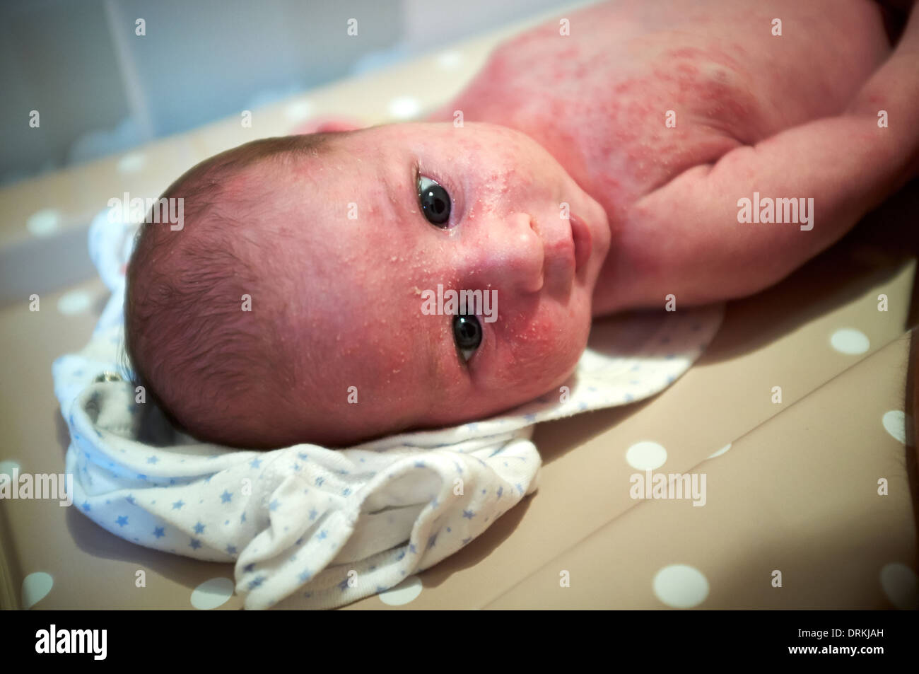 A new born lies on a changing mate with clear neonatal acne or baby