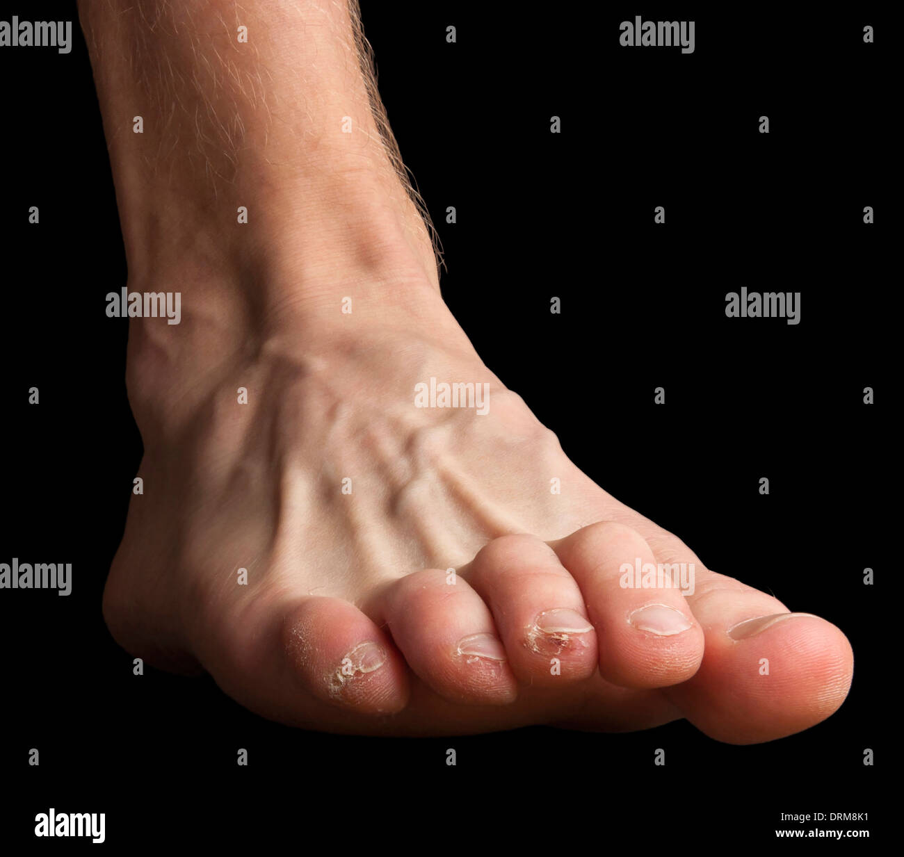 A human foot with hurt toes. Skinning skin and broken blisters and one blood blister. Stock Photo