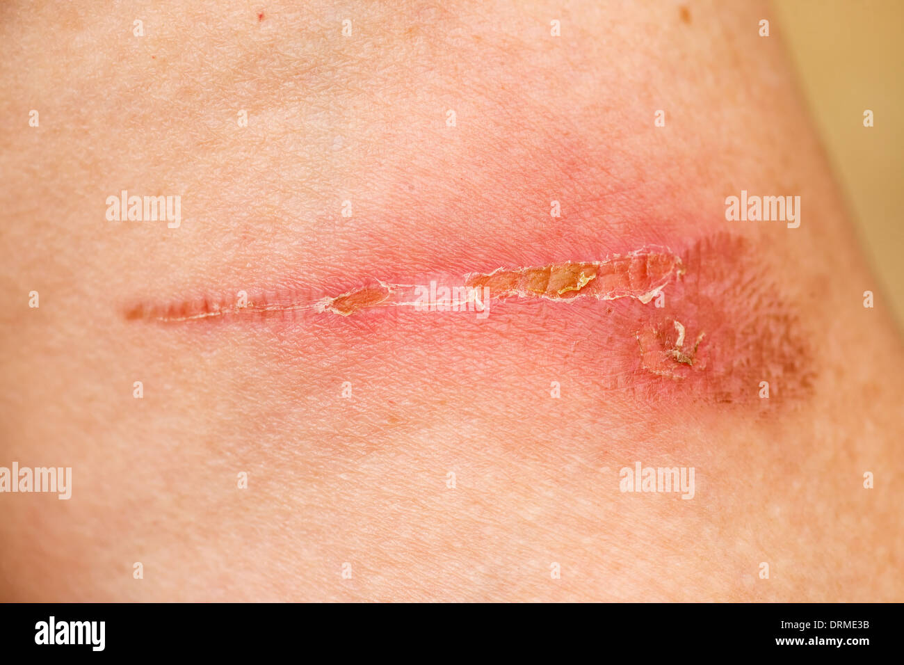 Burn mark skin hi-res stock photography and images - Alamy