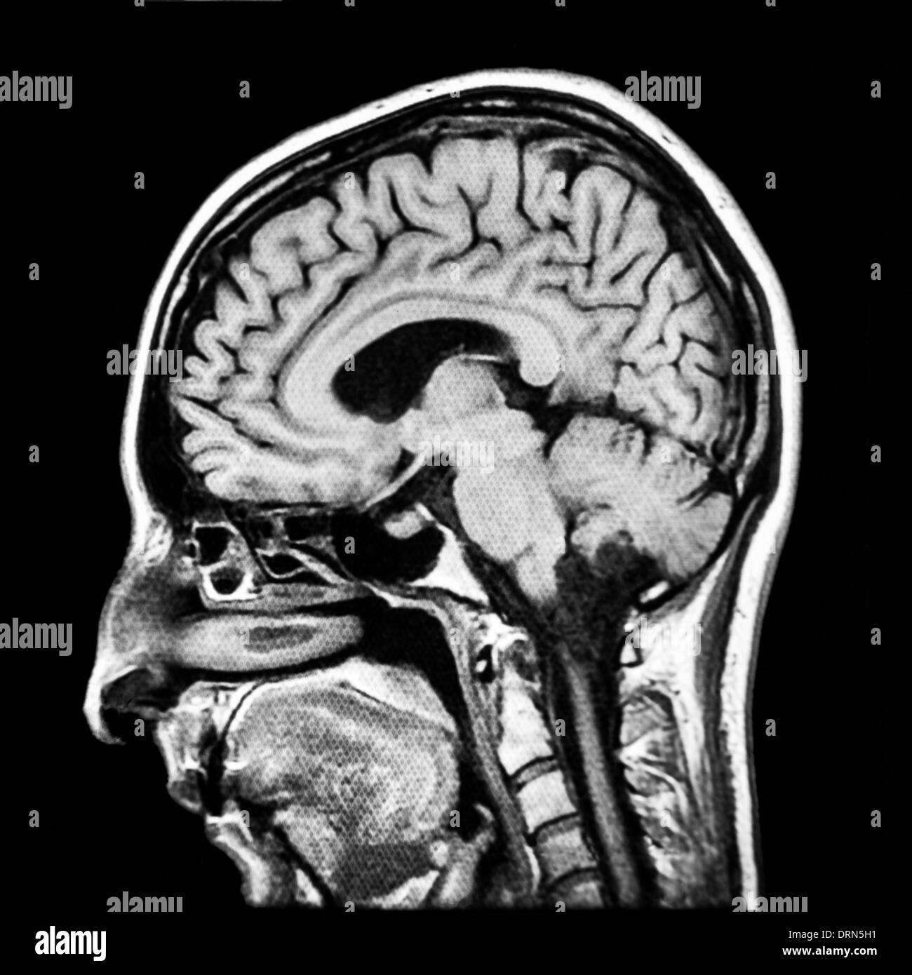 Vertical section of human brain MRI scan Stock Photo