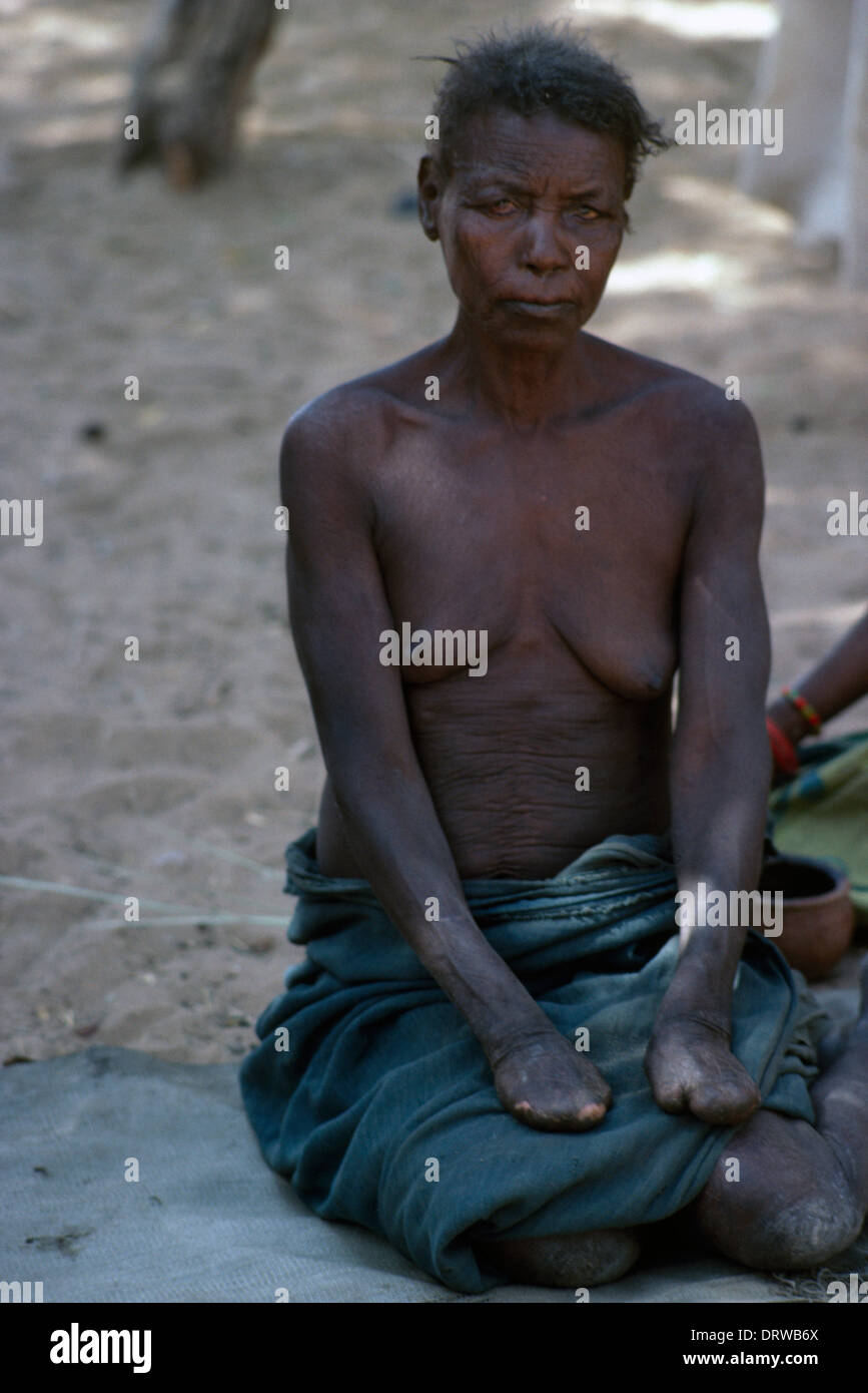 Geneina Sudan Woman - Leprosy Victim Stock Photo
