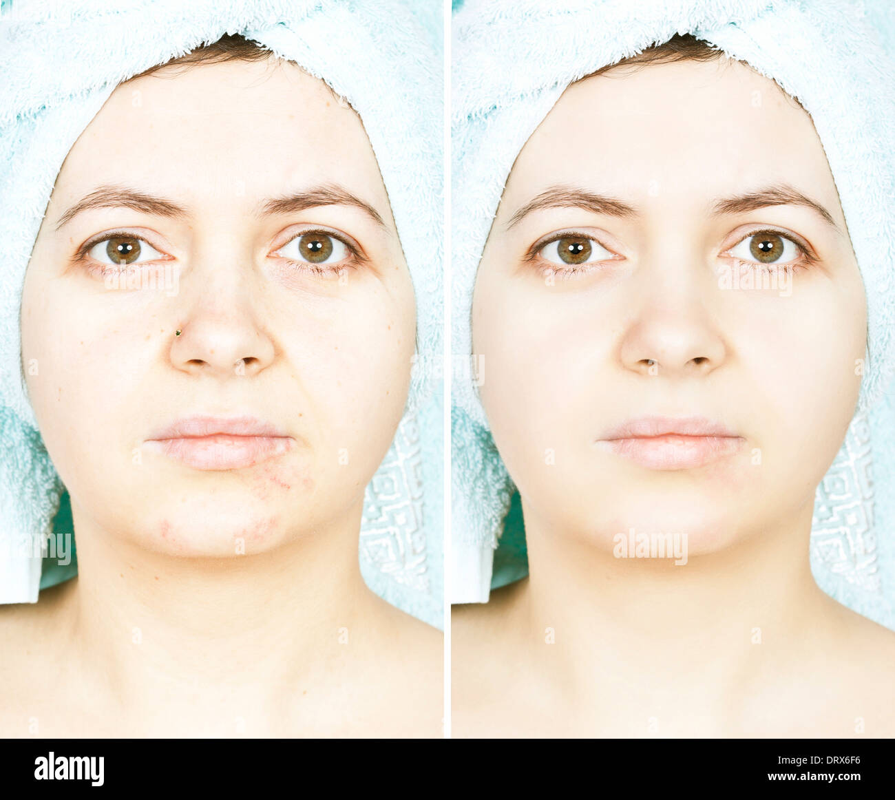Before and after woman skin with scars Stock Photo