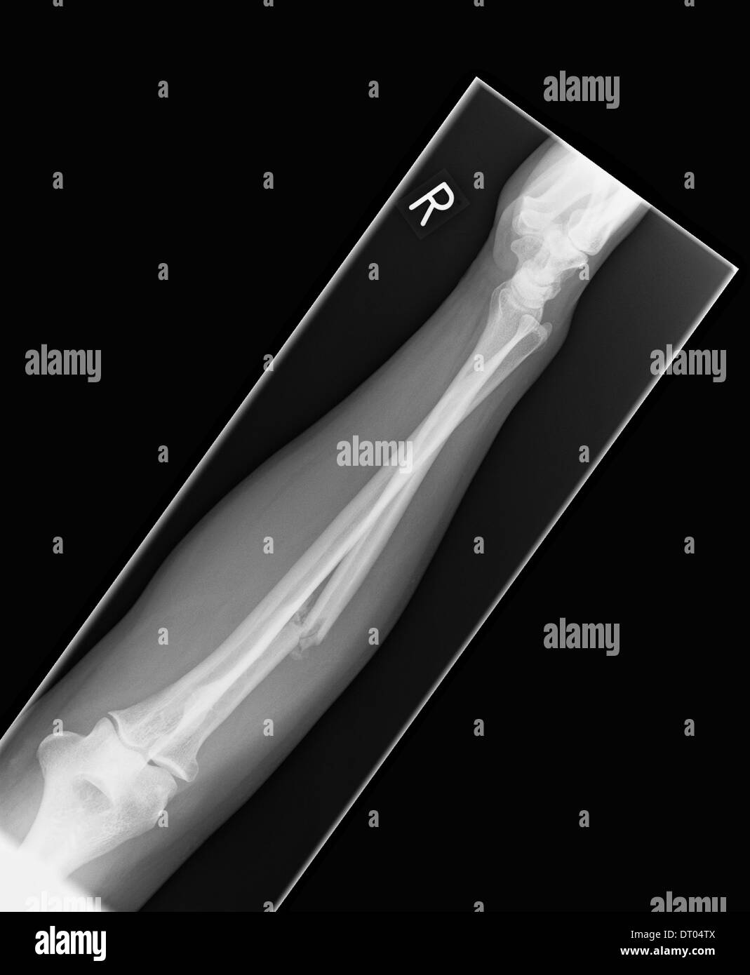 Xray of human right forearm displays fracture of the radial bone Stock