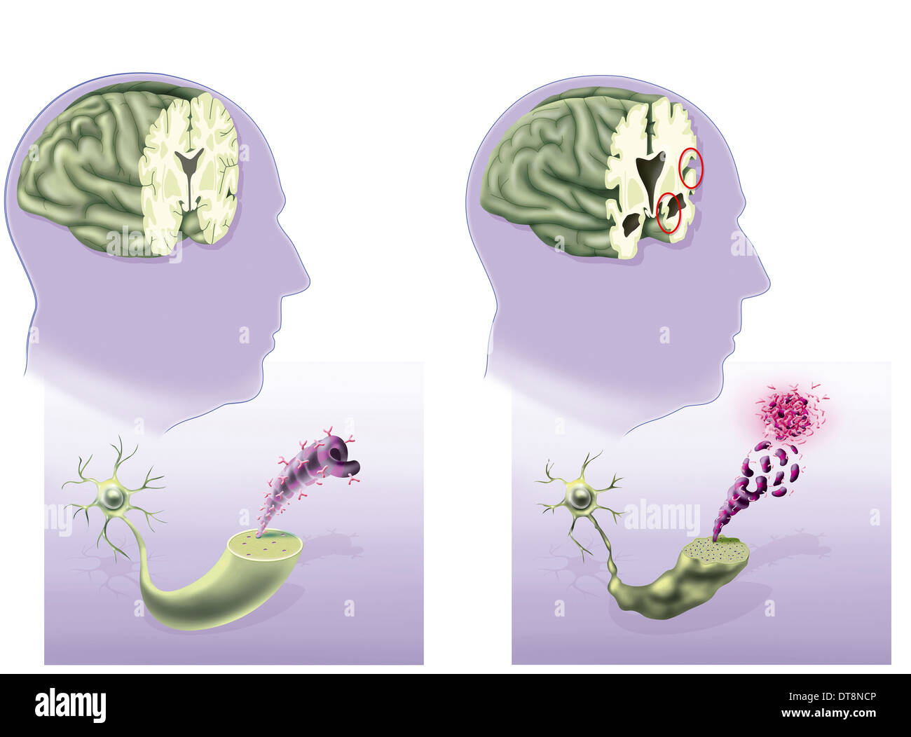 ALZHEIMER'S DISEASE, DRAWING Stock Photo
