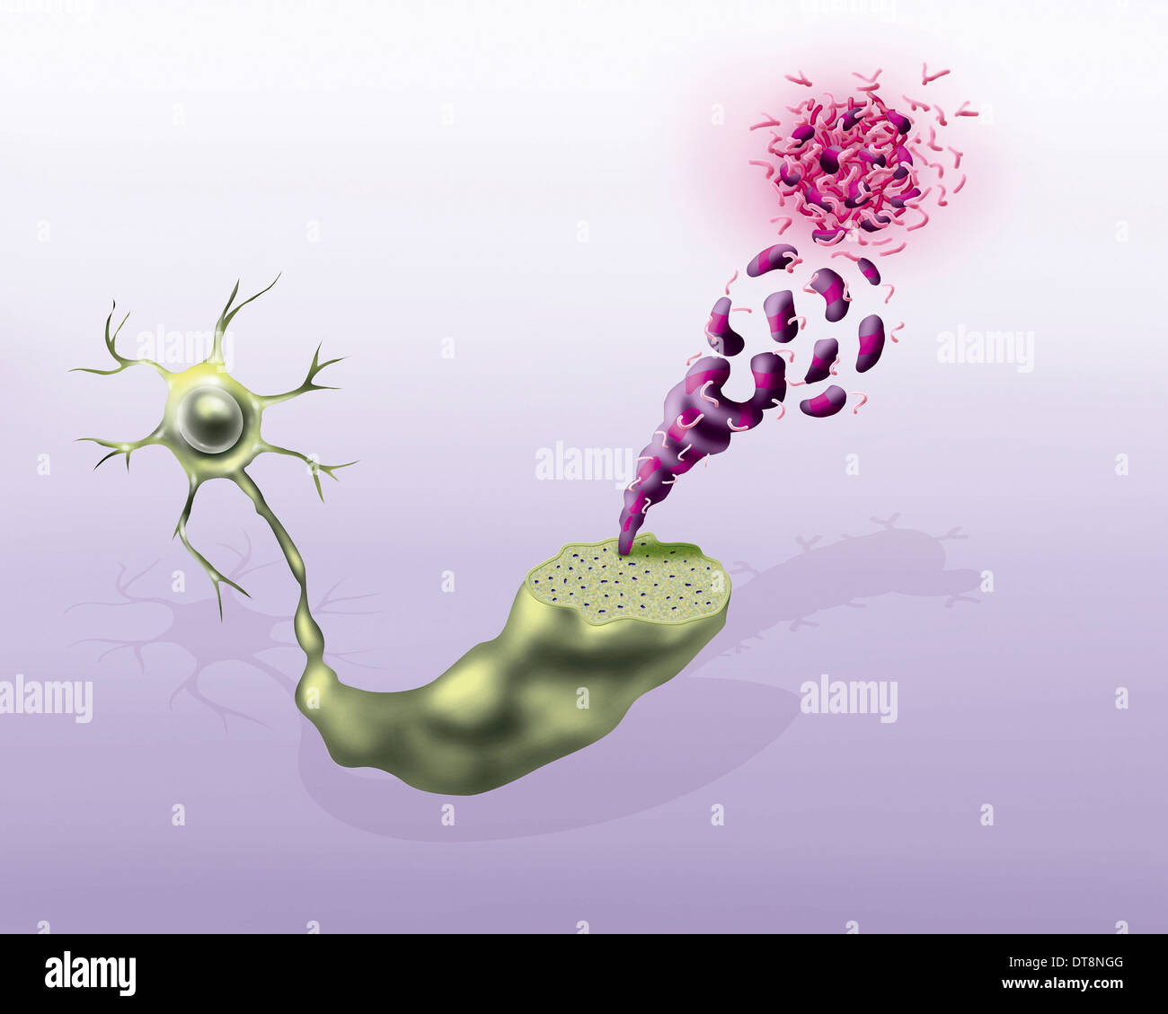 Senile Plaques Alzheimers Disease