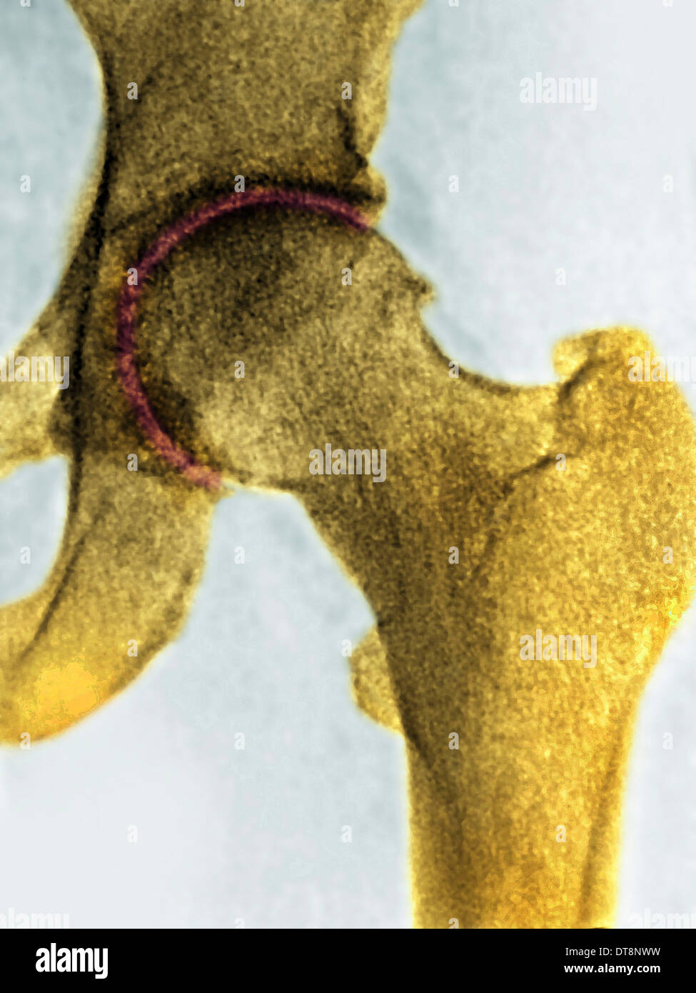 HIP OSTEOARTHRITIS, XRAY Stock Photo Alamy