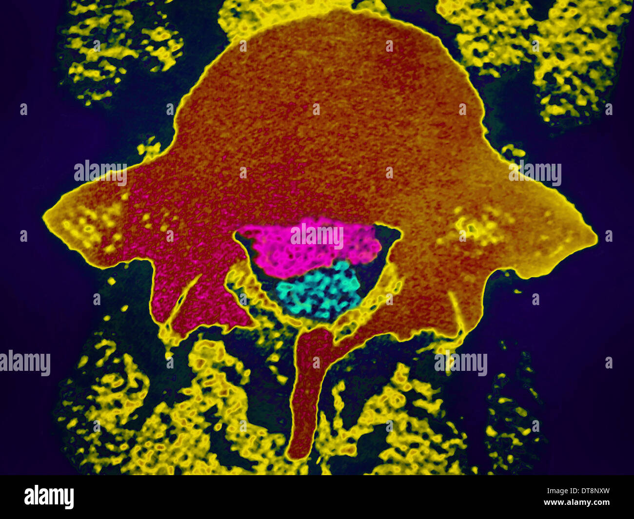 herniated-disk-ct-scan-stock-photo-alamy