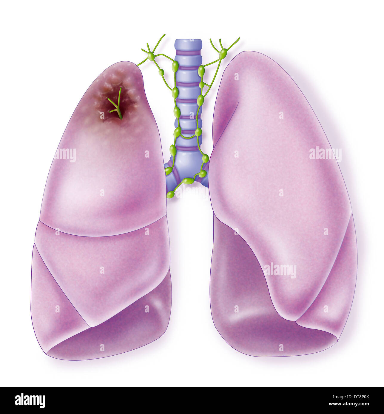 LUNG CANCER, DRAWING Stock Photo