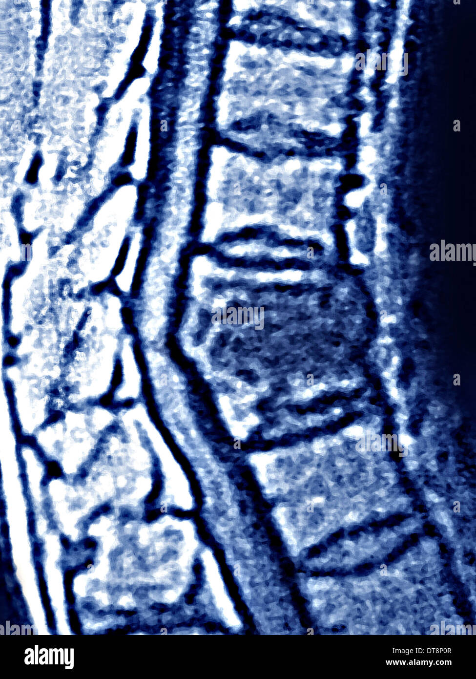 TUBERCULOSIS IN THE BONES, MRI Stock Photo