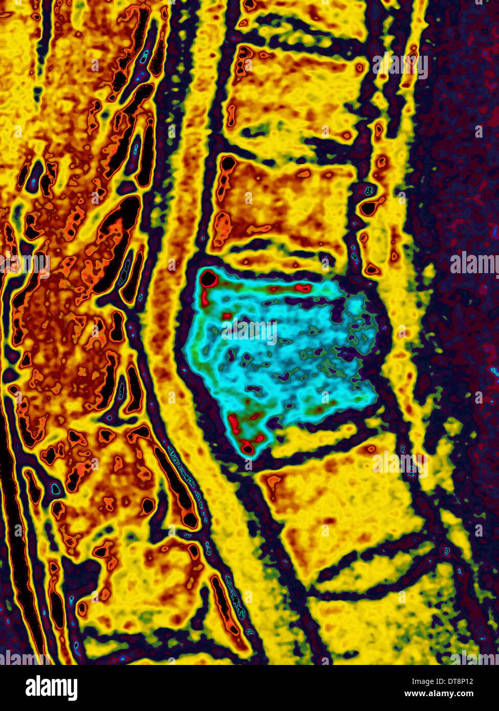 TUBERCULOSIS IN THE BONES, MRI Stock Photo