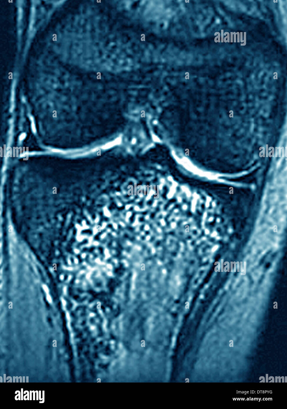 OSTEOSARCOMA, MRI Stock Photo