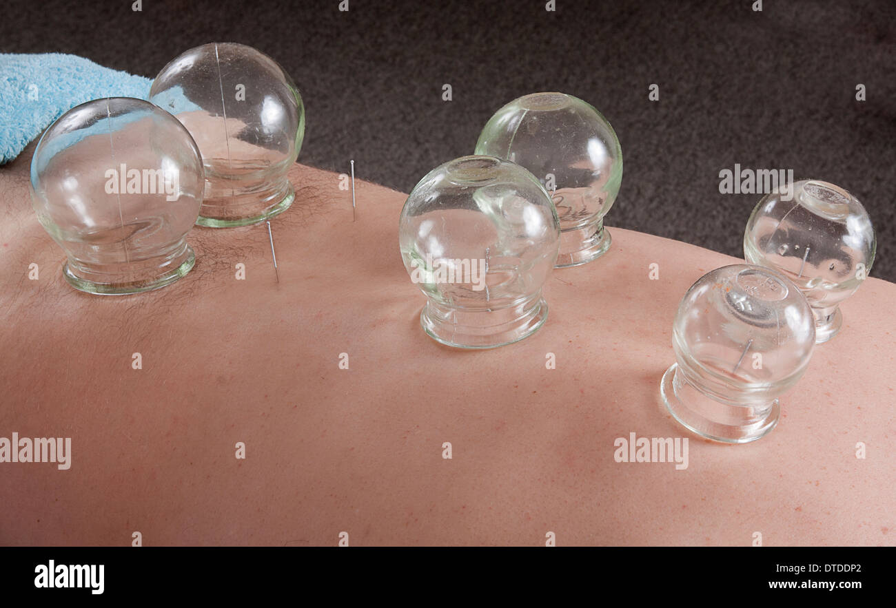 cupping technique as part of acupuncture treatment on male adult for back pain Stock Photo Alamy