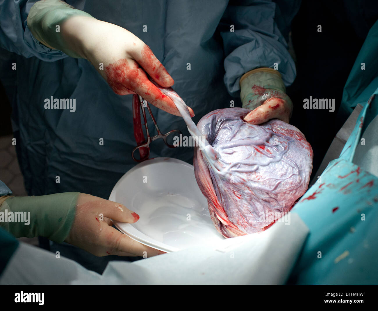 Human placenta and umbilical cord being removed after childbirth Stock Photo