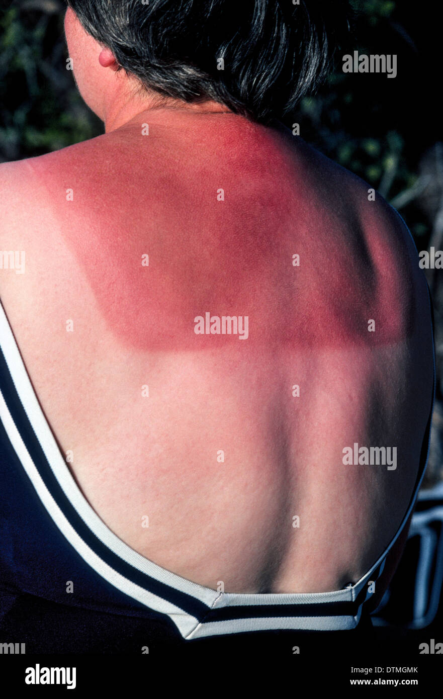 Sunburn Stock Photos & Sunburn Stock Images Alamy