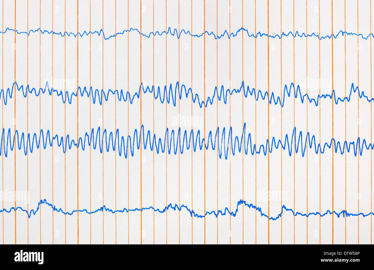 Electrocardiogram ecg hi-res stock photography and images - Alamy