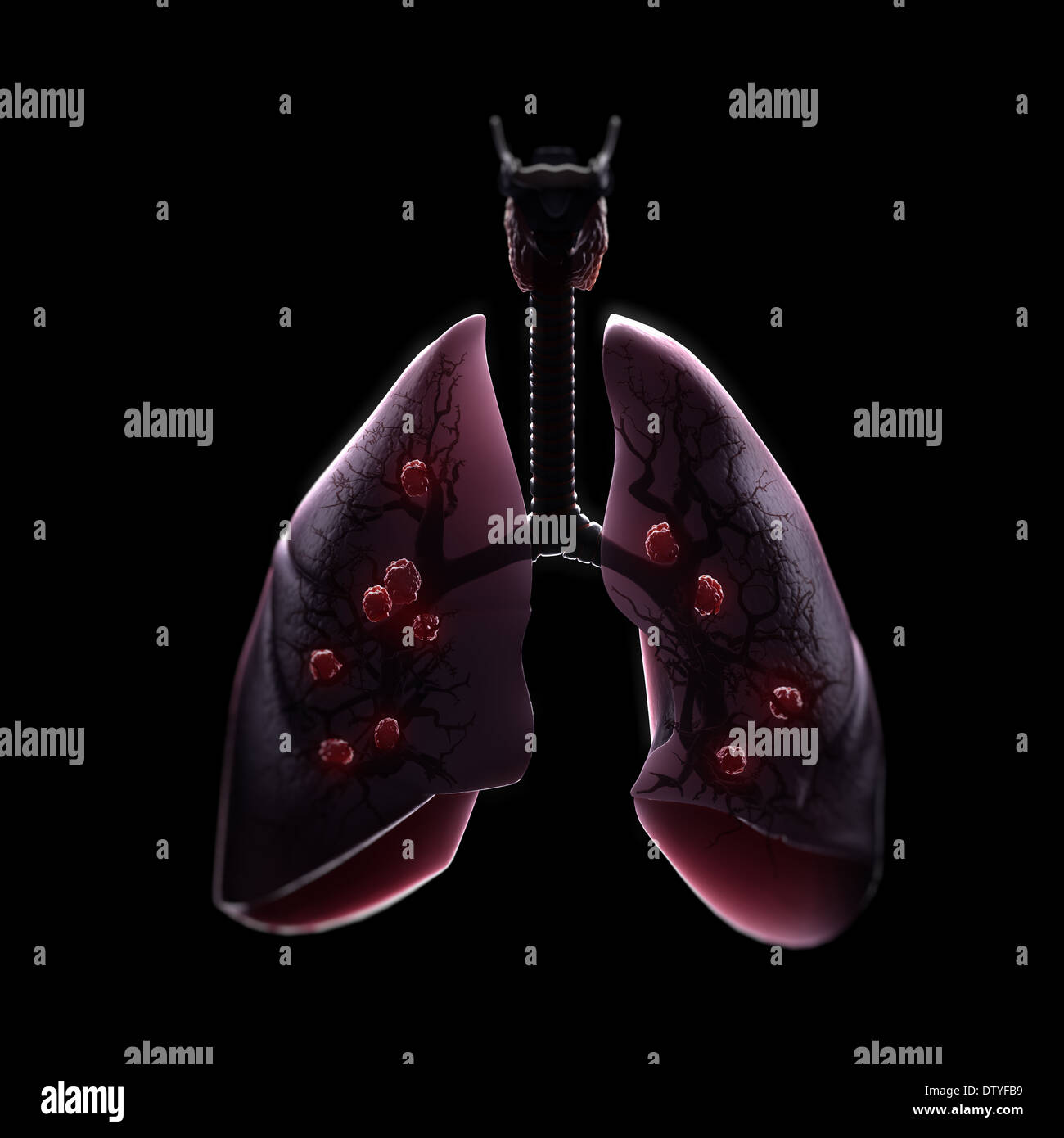 Multiple Lung Tumors Stock Photo