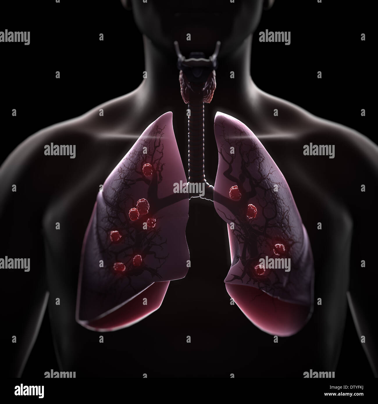 Multiple Lung Tumors Stock Photo