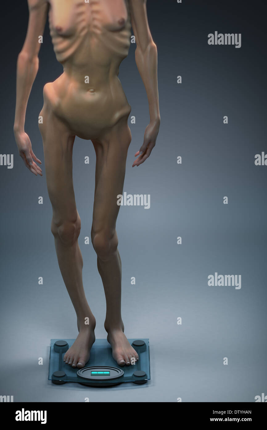 anorexic grannys Body dysmorphia disorder hi-res stock photography and images - Alamy