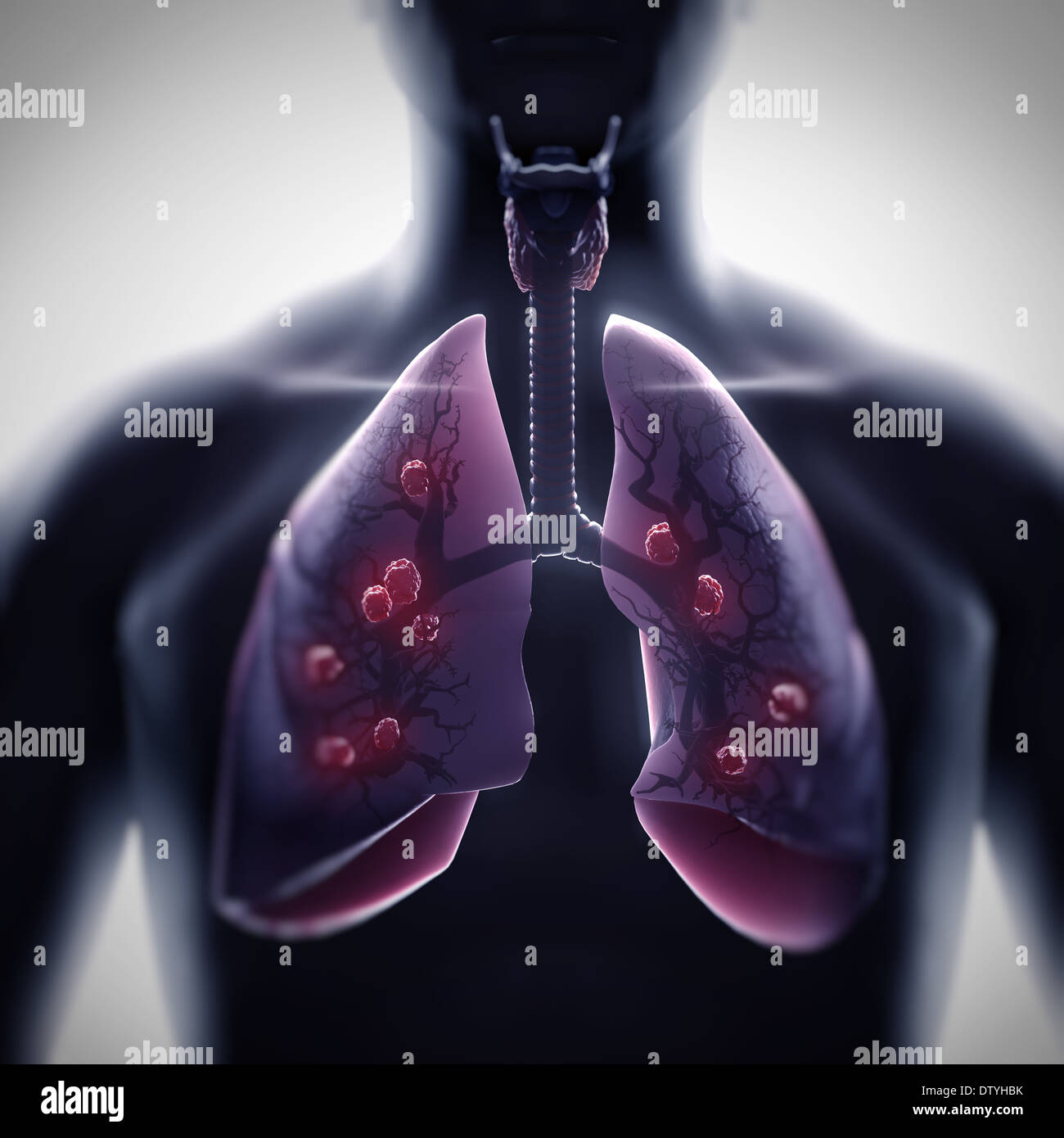 Multiple Lung Tumors Stock Photo