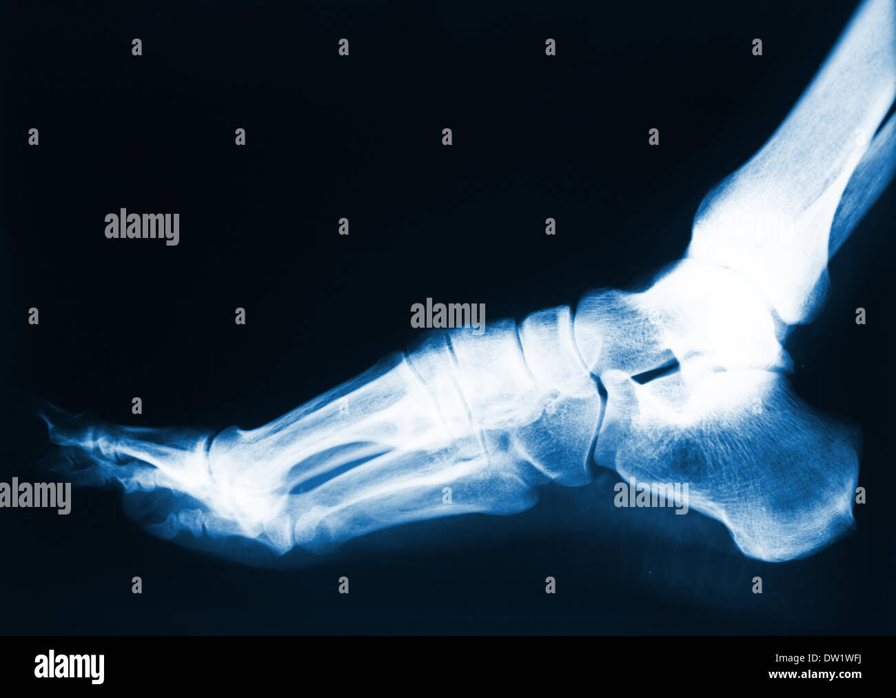 foot x-ray Stock Photo